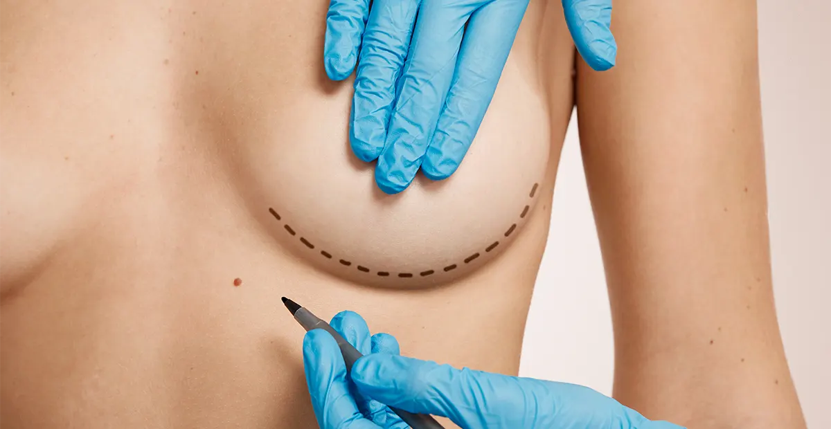 Levantamiento de senos