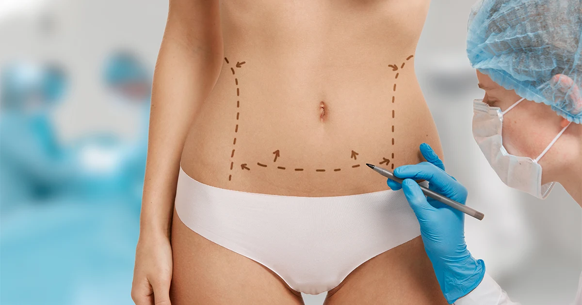 Liposucción Abdominal